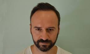 Hair Transplant