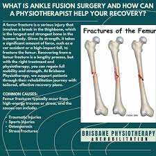 Image result for Femur Bone