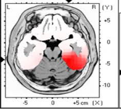 Image result for Postconcussion Syndrome