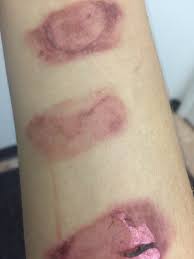 Aftermath salt and ice challenge. Is My Salt And Ice Challenge Scar Permanent I Ve Tried Everything To Get Rid Of It Photo