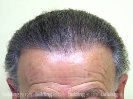 Sep 30, 2019 · averages the number of hairs that someone has on their head can vary by individual. How Many Donor Grafts Does An Average Person Have Wrassman M D Baldingblog