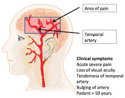 Image result for Acute Localized Headache