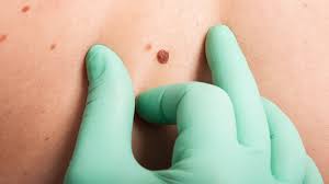 If breast cancer is diagnosed at an early enough stage, it's treatable. Do You Know The 4 Main Types Of Skin Cancer