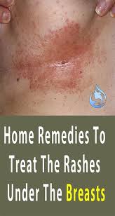 Image result for Intertrigo under breasts