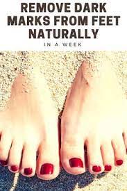 How To Remove Dark Marks From Feet Naturally Dark Spots On Skin Dark Spots On Legs Glowing Dark Skin