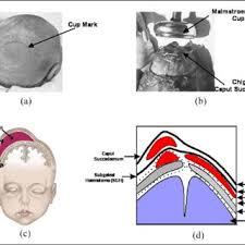 Image result for Vacuum Caput