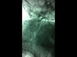 Sag Kol Sol Kol Tansiyon Farki Takayasu Arteriti Youtube