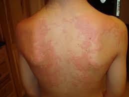 Anything from chronic ear inflammation, gastrointestinal problems, and chronic diarrhea to chronic gas, licking their feet, or an itchy rear end. Allergy Specifics Allergicchild