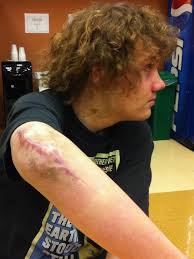 Physical, mental wounds slow to heal for teen in deadly Griswold crash