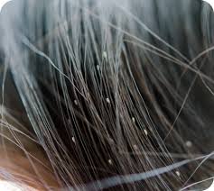 Image result for lice vs dandruff