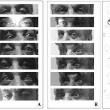 Pdf Neurosyphilis Presenting With Ptosis And Diplopia As The First Complaints Case Report