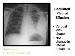 Us scan they can be identified clearly and it is very. Pleural Effusion In Major Fissure Chest Pa Upright Pneumonia In Rul Mass Like Lesion In Right Lower Chest Ppt Download