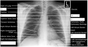 Chest X Ray Labelling Pa Lateral Flashcards Quizlet