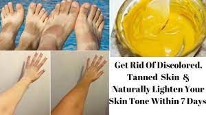 How To Get Rid Of Uneven Discolored Tanned Skin Within 7 Days Get F Tan Skin Skin Tan Removal Skin Discoloration