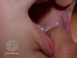 Image result for Hand foot and mouth disease HFMD roof of mouth