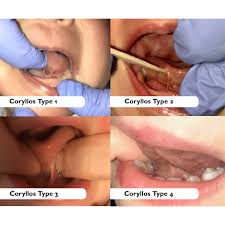 Image result for Ankyloglossia