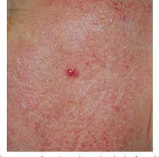 Mccs are dermally based tumors composed of small uniform round blue cells arranged in anastomosing cords, bands and table 4 new icd codes for merkel cell carcinoma. Figure 3 From Merkel Cell Carcinoma Semantic Scholar