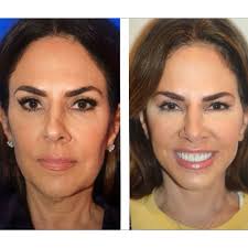 RHONJ's Jennifer Fessler Talks Getting a Natural-Looking Facelift at 54