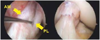 ACL FAQs | Knee | Doctor Articles | Asia Medical Specialists