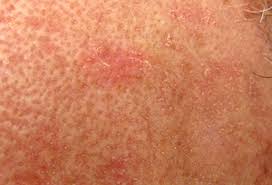 These precancerous lesions (like the. Skin Cancer Nashua Basal Cell Carcinoma New Hampshire Actinic Keratoses