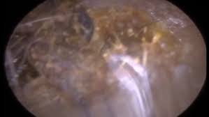 Watch out for more epic ear wax removal videos! Video Disgusting Moment Ear Wax Build Up Removed In Graphic Video Daily Mail Online