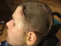 Staples Removed from Skull