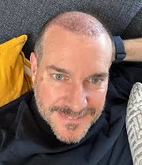 Since i went to Turkey for my hair transplant none of you has care about me  Everyone left me in this hurdles alone it fine am doing well ❤️‍🩹 If you  truly