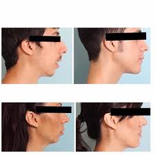 Jaw Surgery Corrective Jaw Or Orthognathic Surgery Is Performed By An Oral And Maxillofacial Surgeon Oms To Corre Jaw Surgery Orthognathic Surgery Surgery