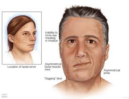 How contagious is Bell's palsy?