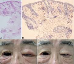 Severe cases of both acne rosacea and blepharitis can lead to a severe periorbital erythematous edema known as morbihan syndrome. Successful Treatment Of Morbihan Disease With Long Term Minocycline And Its Association With Mast Cell Infiltration Html Acta Dermato Venereologica
