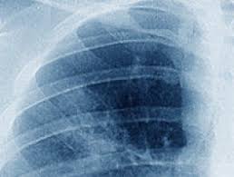 Jaundice (yellowing of the skin and eyes) lumps in the neck and/or collarbone region; Esmo 2016 Pembrolizumab New Option For First Line Treatment Of Patients With Advanced Lung Cancer And High Pd L1 Expression Ecancer