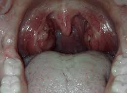 Image result for Peritonsillar Abscess