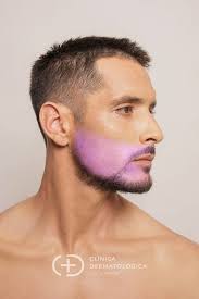 A Laser Barba Luz Pulsada Barba Luz Pulsada Como Eliminar Los Bigotes Para  Siempre Hombres La