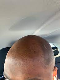 Check spelling or type a new query. How Do I Get Ride Of The Dark Shadow On My Head After Shaving Clean Bald