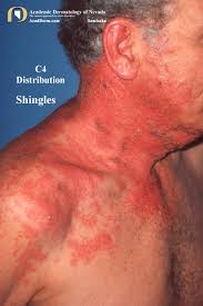 Image result for shingles