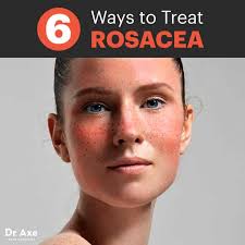 rosacea treatment 6 natural remes