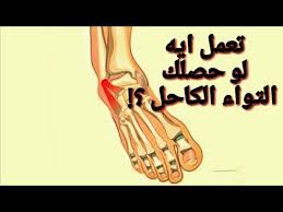 علاج التواء الكاحل وتورمه Youtube