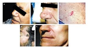 Large cell carcinoma is a type of lung cancer. Basal Cell Carcinoma Nejm