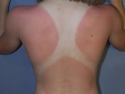 Sunburn causes a range of problems like pain, premature ageing, precancerous lesions, and skin cancer. Sunburn Dermnet Nz