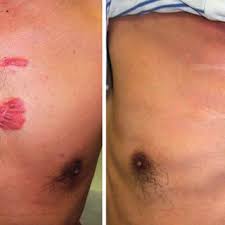 Pdf Keloids And Hypertrophic Scars Can Now Be Cured Completely Recent Progress In Our Understanding Of The Pathogenesis Of Keloids And Hypertrophic Scars And The Most Promising Current Therapeutic Strategy