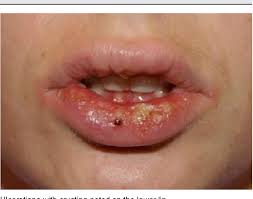 You get the herpes simplex 1 virus by coming into contact with another person who has the virus. Pdf Pediatric Herpes Simplex Virus Infections An Evidence Based Approach To Treatment Semantic Scholar