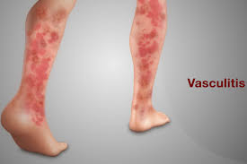 Image result for Vasculitis