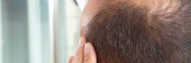 If you're concerned about hair loss, or see unusual hair loss in your child, contact your dermatologist who can diagnose and treat the conditions that lead to this problem. Hair Loss Treatment Norris Dermatology Laser Northwest Portland