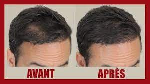 We did not find results for: Se Coiffer Facilement Quand On Perd Ses Cheveux Ou Quand On A Les Cheveux Tres Fins Youtube