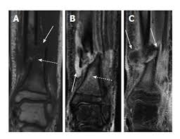 Image result for Osteomyelitis