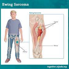 If you have bone cancer, the doctor will want to find out how far it has spread. Ewing Sarcoma In Children And Teens Together