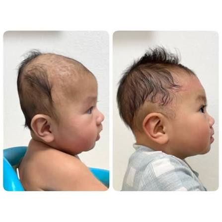 كيف يعرف الأهل أن علاج تسطح الرأس يسير في الاتجاه الصحيح؟#lasvegaspediatrics  #childrensorthotics #cranialband #cranialhelmet ...