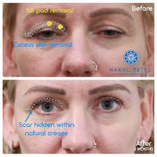 Upper Eyelid Reshaping This lady wanted to her eyes to look fresher and  less tired. She underwent Upper Eyelid Reshaping (aka Upper Blepharoplasty)  by removing the excess skin and fat pads beneath