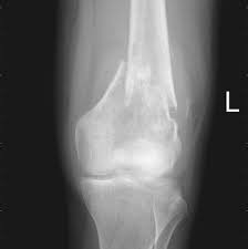 In bone cancer, bone or cartilage cells sometimes change and no longer grow or behave normally. Osteosarcoma Radiology Reference Article Radiopaedia Org