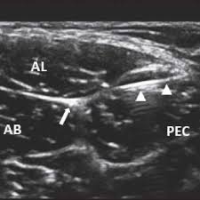 The muscle does adduct and internally rotate the thigh but its primary function is hip flexion. Ultrasound View Of Obturator Nerve Pec Pectineus Muscle Al Adductor Download Scientific Diagram